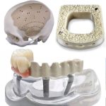 Ưu điểm và hạn chế của PEEK so với kim loại