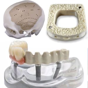Ưu điểm và hạn chế của PEEK so với kim loại